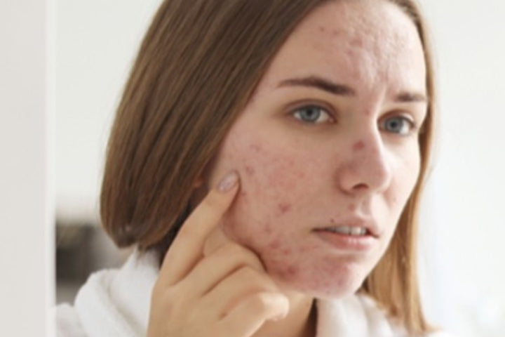 How to Clear Cystic Acne