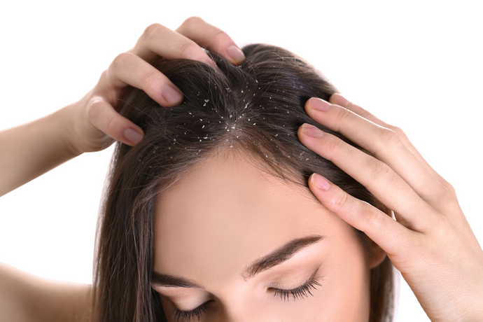 The Right Way to Deal with Dandruff