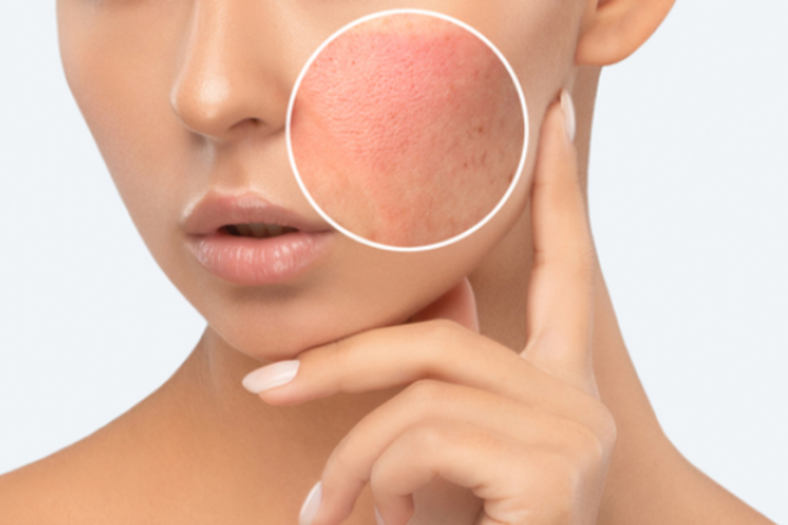 Your Guide to Treating Contact Dermatitis